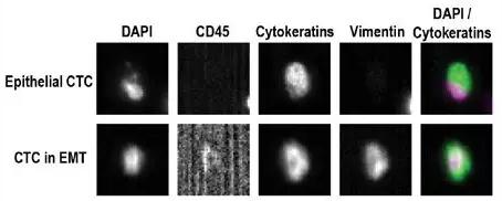 CellSearch 檢測CTCs代表性例子的結(jié)果示意圖 CellSearch 檢測CTCs代表性例子的結(jié)果示意圖