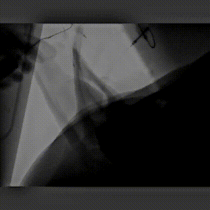 豬耳血管造影，可見枝枝杈杈很多