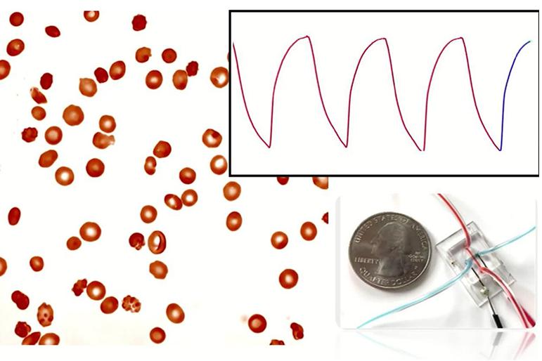 微流控阻抗傳感器可以監(jiān)測(cè)鐮狀細(xì)胞病