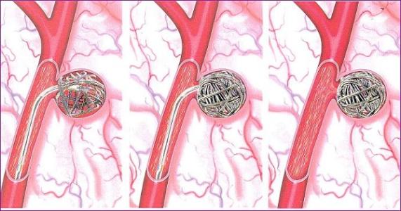 可拉伸的無(wú)線傳感器可以監(jiān)測(cè)腦動(dòng)脈瘤的愈合