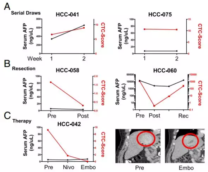 圖4.CTC評(píng)分較血液AFP檢測(cè)系統(tǒng)能夠更靈敏、更特異地檢測(cè)肝癌及監(jiān)控肝癌的治療情況。