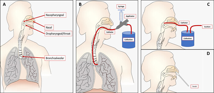 用于呼吸道病毒檢測的微流體樣品制備 用于呼吸道病毒檢測的微流體樣品制備
